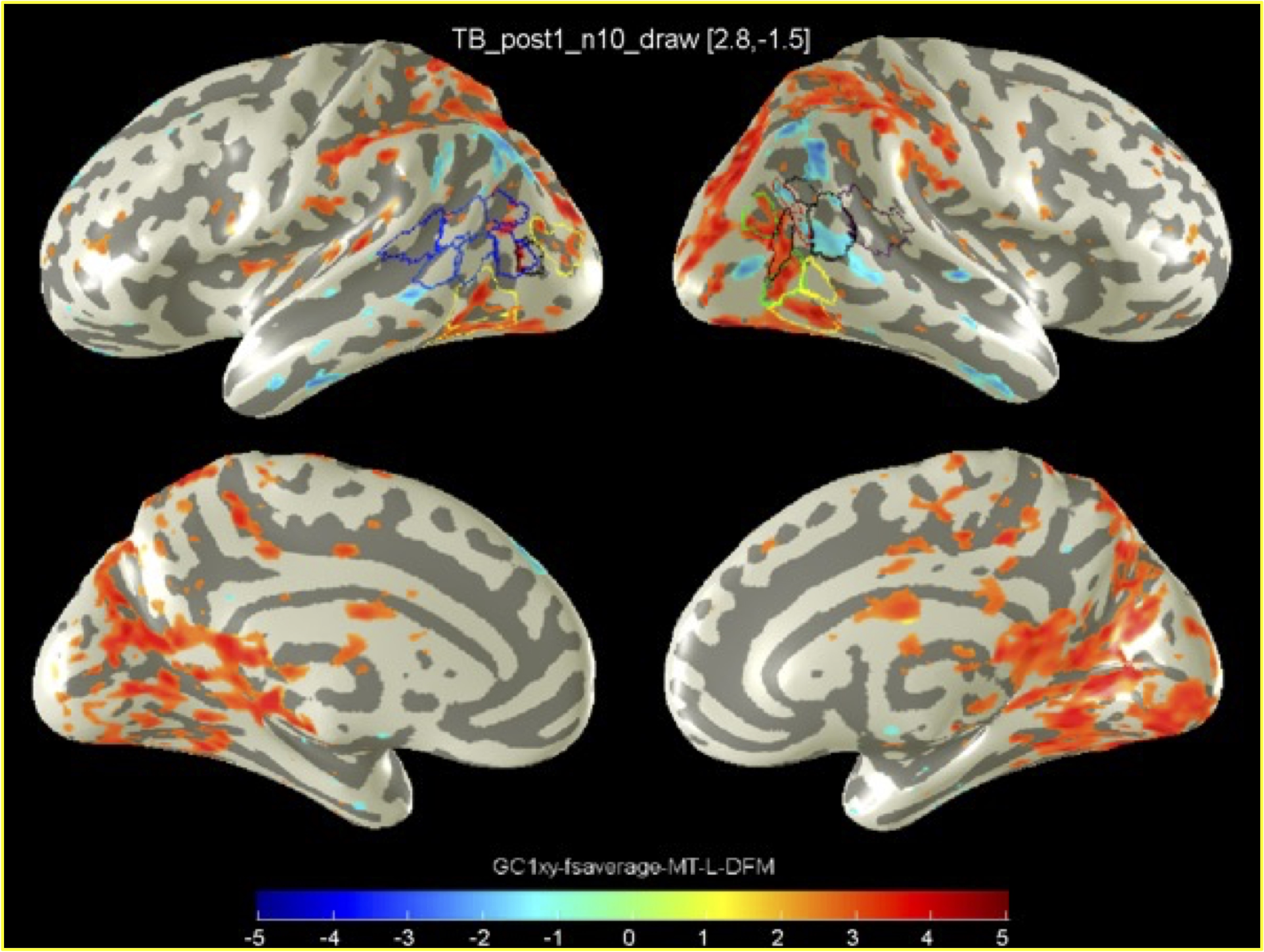 Images of the lateral and medial surface of the inflated human brain showing the average activation of blind people after learning to draw complex line images.